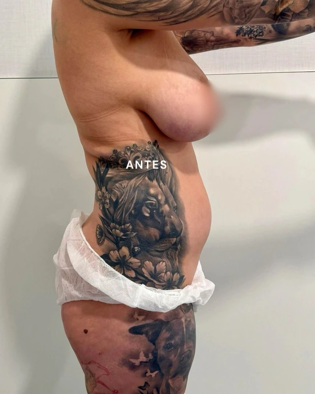 Liposuction, side view before surgery. Original image from the @dr.lmartin carousel