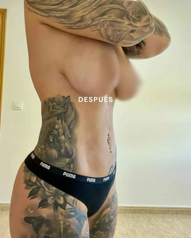Liposuction, side view after surgery. Original image from the same @dr.lmartin carousel